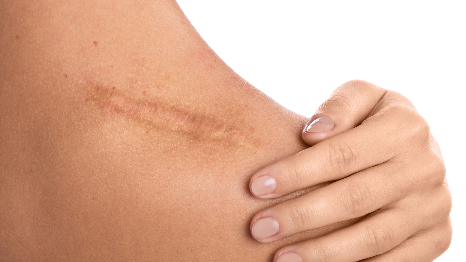 Healed scar on a person’s upper arm with hand gently touching it