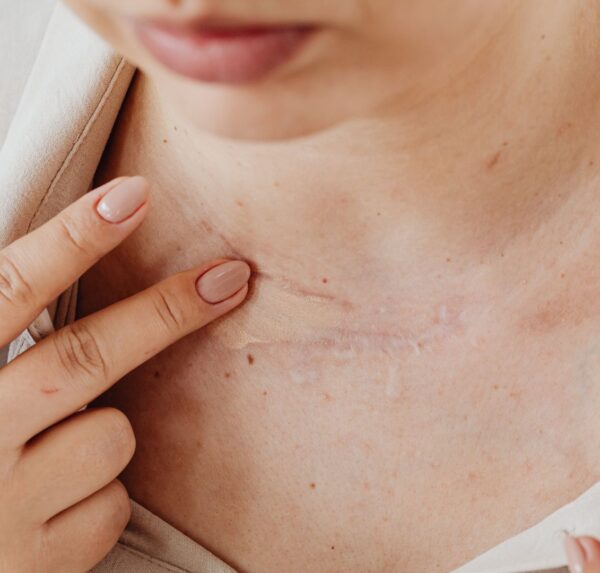 scar-release-therapy-1